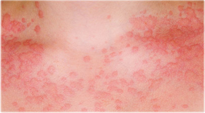 hepatitis hives