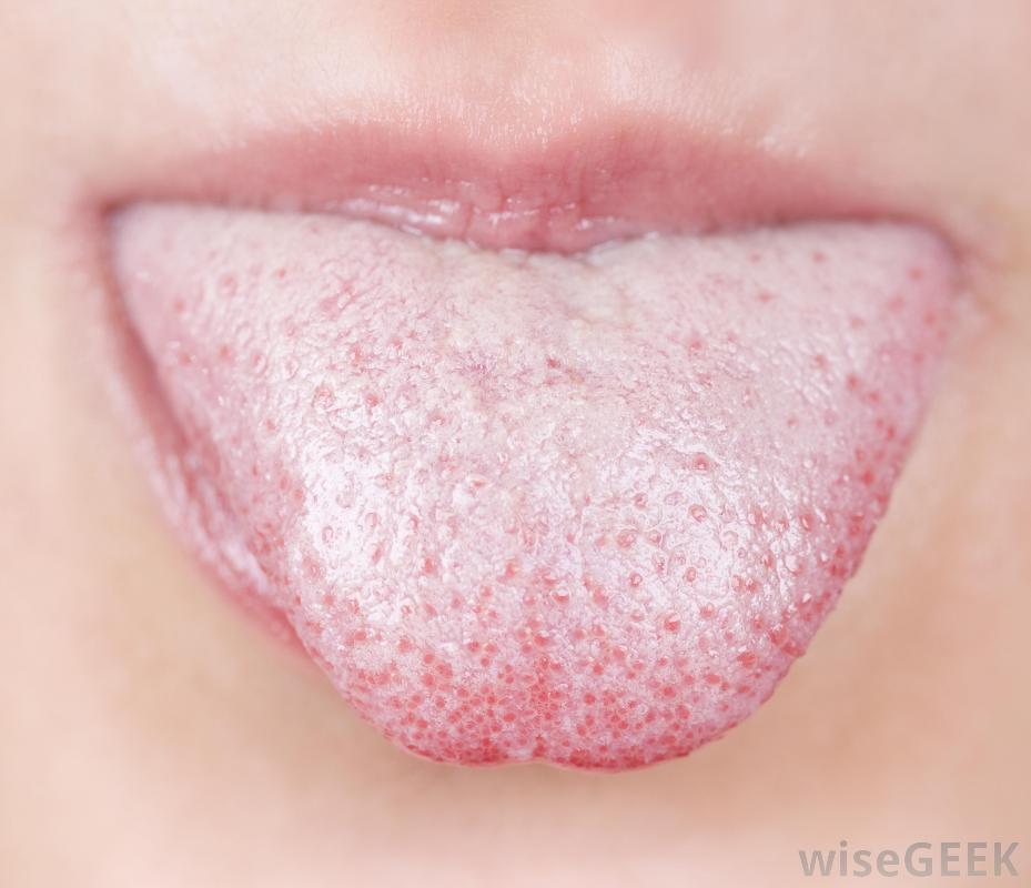 Dry Mouth And White Tongue 100