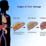 stages of liver cirrhosis hepatitis