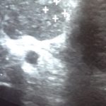 ultrasound spot on liver