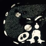 mri cancer spot on liver karen ihlelpc