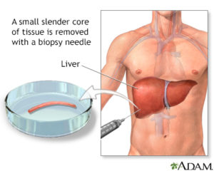 My Liver Biopsy Story