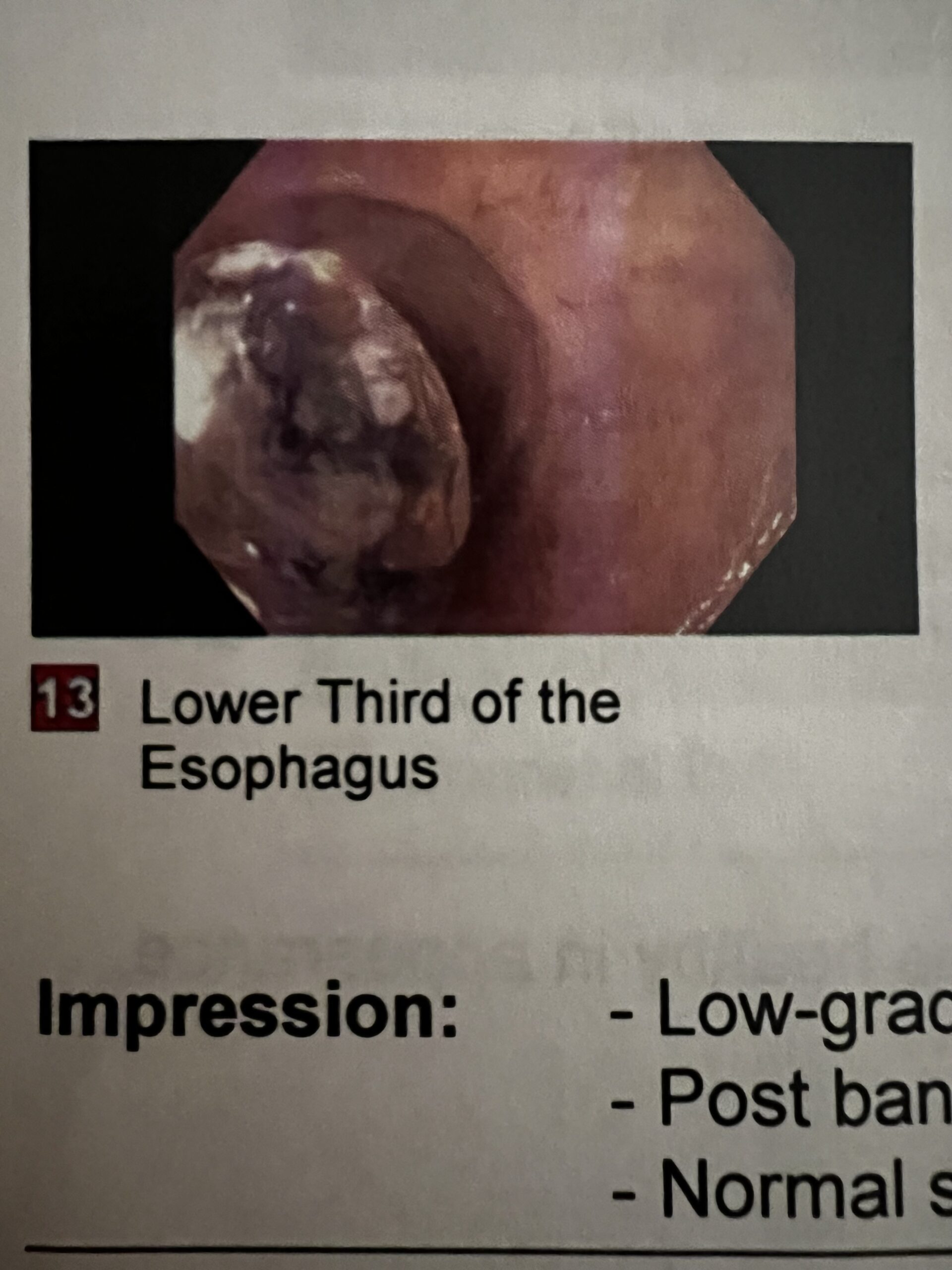 varices post banding scar esophagus ihelpc.com