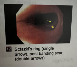 varices post banding scar esophagus ihelpc.com