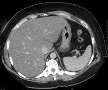 fatty liver nafld ihelpc.com