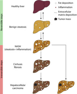 MASLD vs MASH: Where are you on the spectrum karen hoyt ihelpc